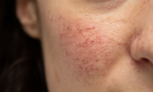 ROSACEA: Peroral dermatitt kan av og til likne på rosacea, men ved rosacea man finner ofte utslett i kinn og panne. FOTO: NTB Scanpix /shutterstock ROSACEA: Peroral dermatitt kan av og til likne på rosacea, men ved rosacea man finner ofte utslett i kinn og panne. FOTO: NTB Scanpix /shutterstock